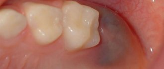 Why do my gums turn blue?