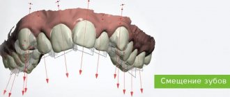 почему смещаются зубы