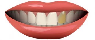 Why does a dead tooth darken?