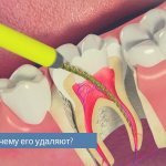 Why is the nerve in a tooth removed?