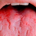 Why does the tongue bleed?