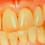 Почему желтеют зубы