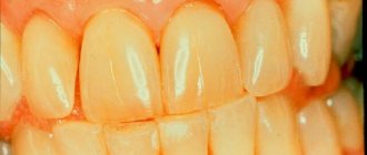 Why do teeth turn yellow?