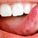 Под языком пузырь может быть сигналом о серьезном заболевании