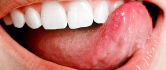 Под языком пузырь может быть сигналом о серьезном заболевании