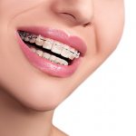 details about the combined braces system