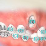Indications and contraindications for orthodontic tooth traction