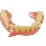 Breakage of a removable denture