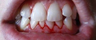 gum damage caused by floss