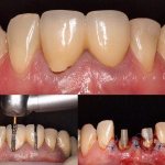 Повторное протезирование сильно разрушенных зубов