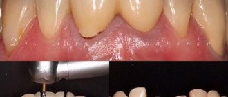 Re-prosthetics for severely damaged teeth