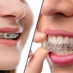 Benefits of correcting your bite with mouthguards