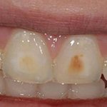Причины гипоплазии эмали зубов