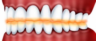 Причины повышенной стираемости зубов