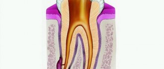 causes of dental cysts
