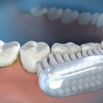 причины возникновения зубного камня