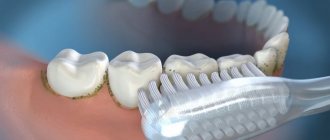 причины возникновения зубного камня