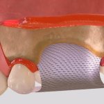 Application of a membrane for bone grafting during implantation