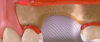 Application of a membrane for bone grafting during implantation