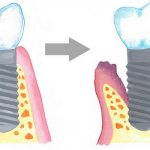 Признаки отторжения зубного импланта