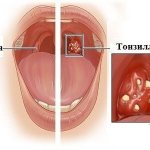 signs of tonsillitis