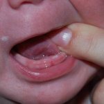 Erupting the first teeth is a big challenge for a child.