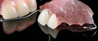 протезы на зубы vertex