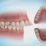Protrusion of teeth
