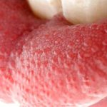 Pimples on a child&#39;s tongue