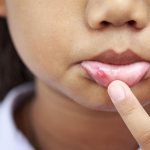 blisters on a child&#39;s mouth
