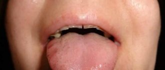 Sores on the sides of the tongue from teeth