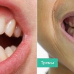 Difference between diastema and trema