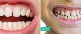 Difference between diastema and trema