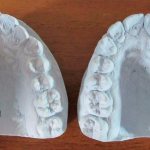 Types of dental impressions