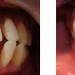 different stages of periodontitis