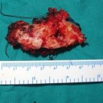 Recurrent ameloblastoma: a clinical case