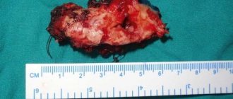 Recurrent ameloblastoma: a clinical case