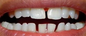Редкие зубы