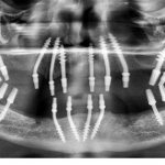 X-ray of basal implantation