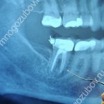 Рентген снимок зуба с бифуркацией