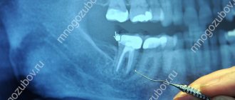 Рентген снимок зуба с бифуркацией