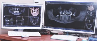 Результаты рентгена челюсти рентгена
