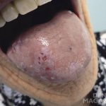 Rice. 1. Erosion and ulcers of the tongue with leukoplakia (before treatment). 