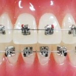 Self-adjusting braces