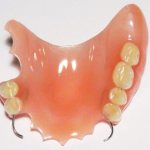 Removable denture with suction cups and palate