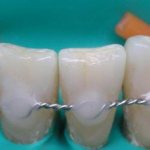 шинирование нижних зубов