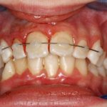 Шинирование травмированного зуба