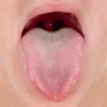 Symptoms and home treatment of uvulitis, causes of swelling and swelling of the uvula in the throat