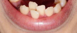 Синдром тесного расположения зубов