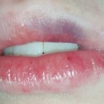 bruise on lip